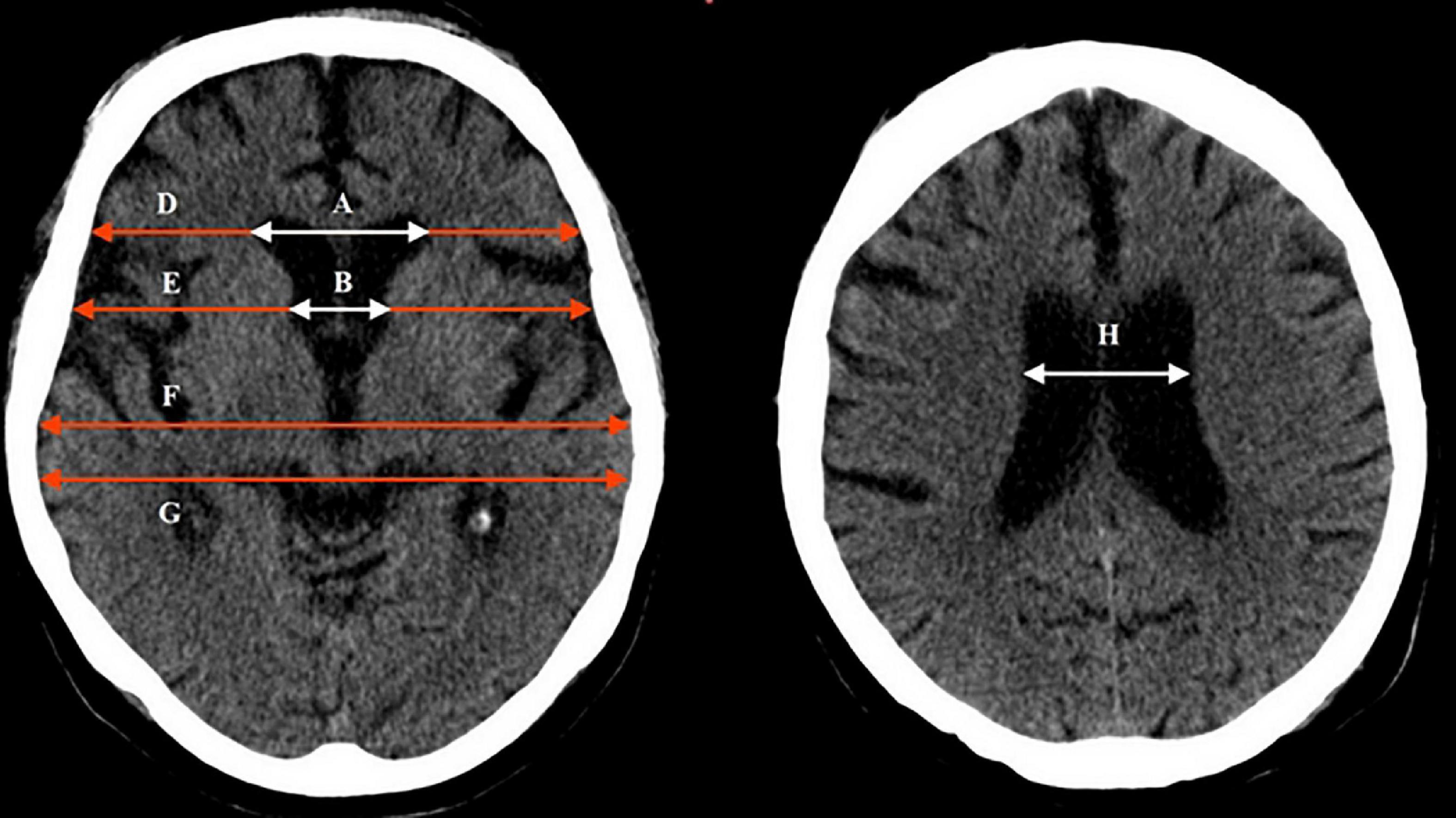 Sclerostin, vascular risk factors, and brain atrophy in excessive drinkers